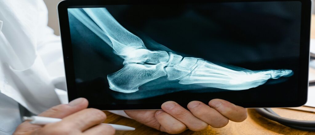 Picture of xray of foot associated with blog on proving damages