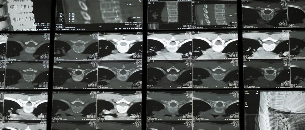 Picture of radiological studies of the central nervous system associated with blog on personal injury anatomy nervous system