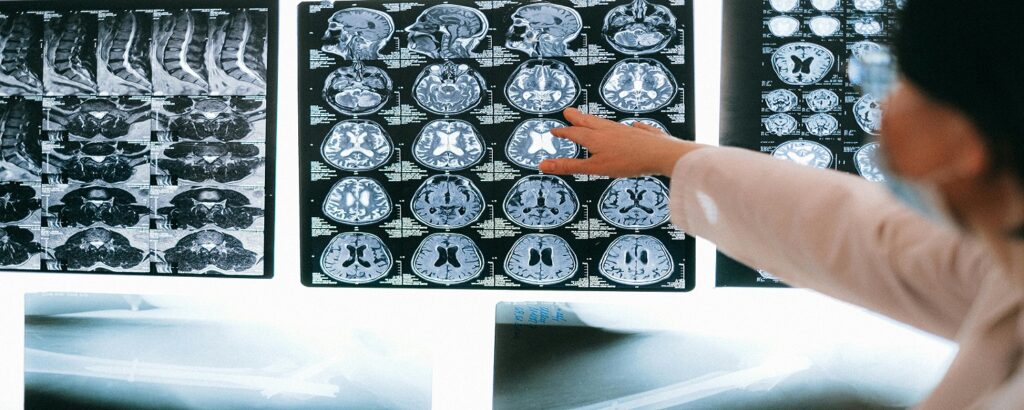 Picture of radiological studies of brain associated with blog on treating traumatic brain inijury