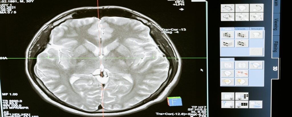 Picture of human brain associated with blog on personal injury tbi.