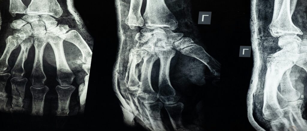 Picture of xrays of hands associated with blog post on proving damages-wakole