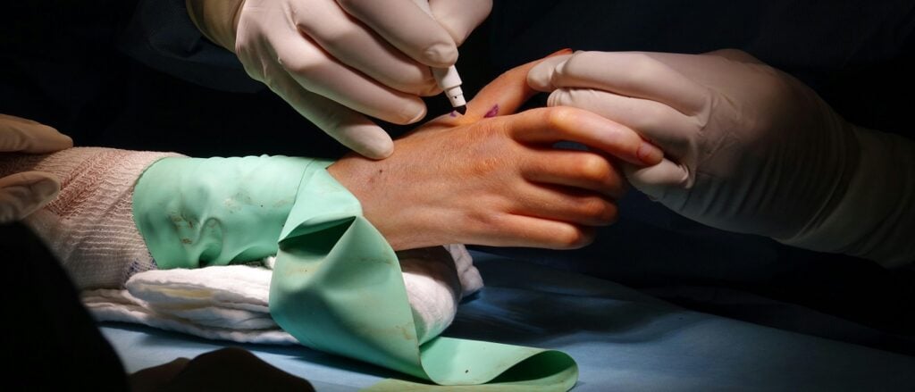 Picture of hand surgery associated with blog on hand injury medical malpractice