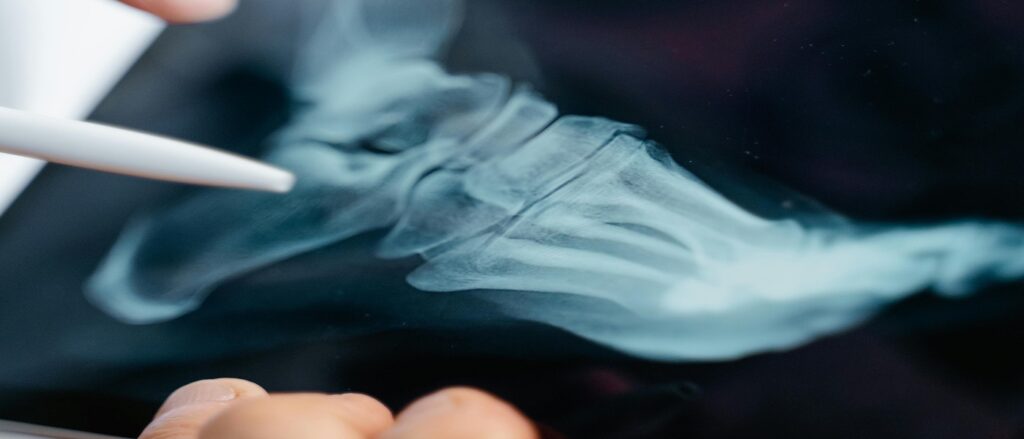 Picture of xray of foot associated with blog on orthopedic medical malpractice